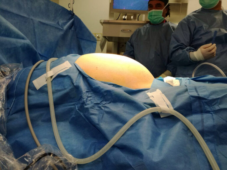Sembrava incinta ma era un’enorme cisti ovarica. Intervento record all’ospedale di Potenza