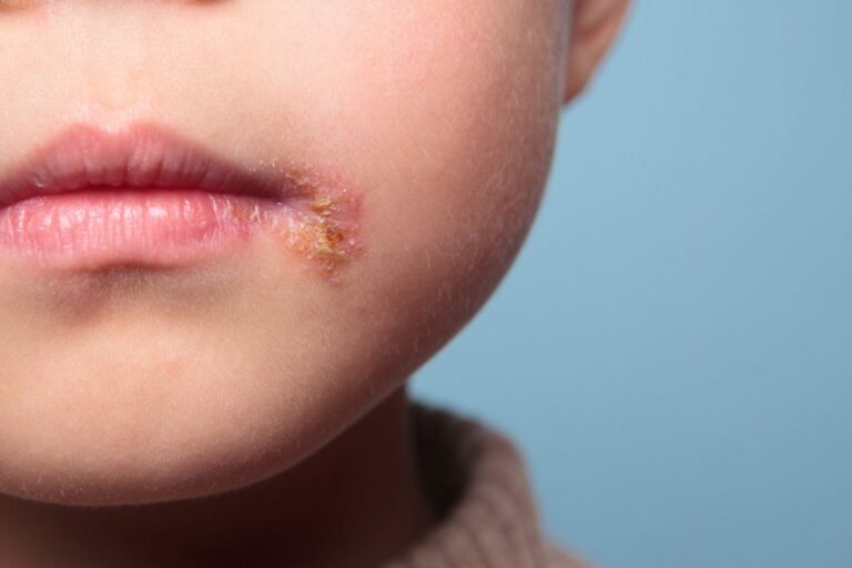 Farmacia 3.0 – l’omeopatia è utile per l’herpes labiale