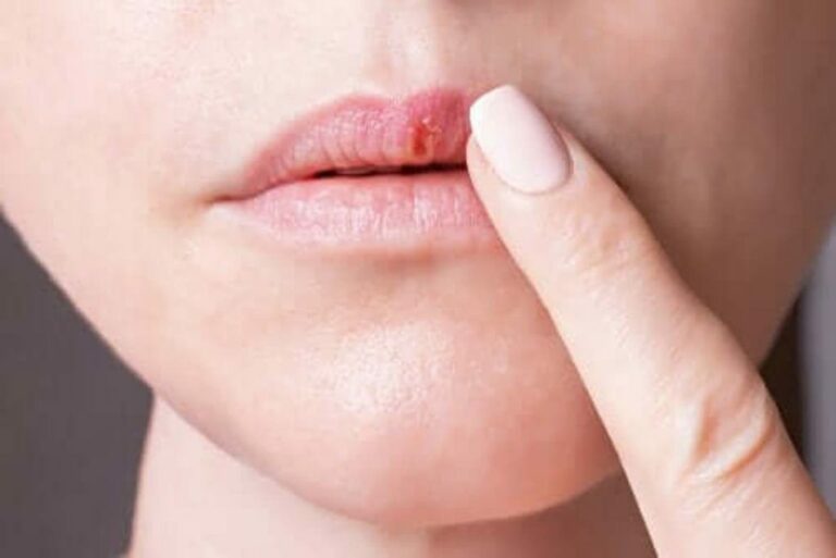 Farmacia 3.0 – i rimedi naturali per combattere l’herpes labiale