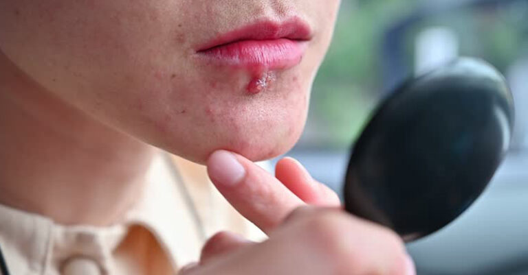 herpes dolore fb ok