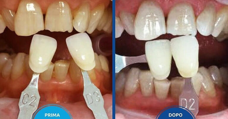 sbiancamento studio dentistico innamorato FB